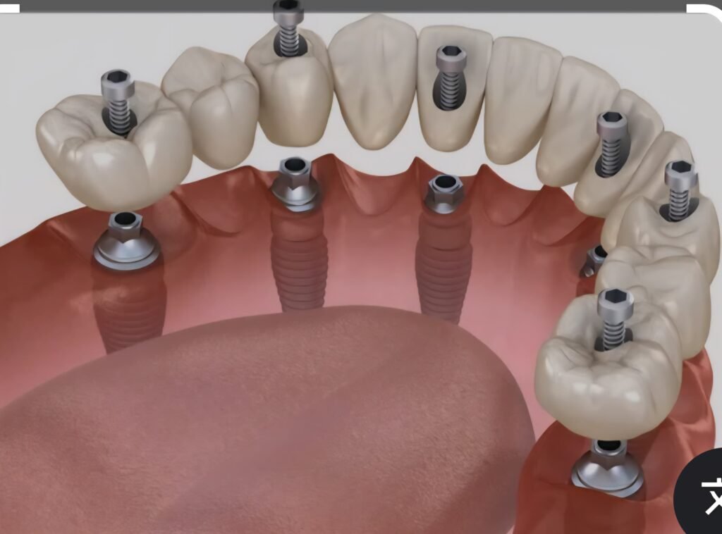 invisalign aligners
