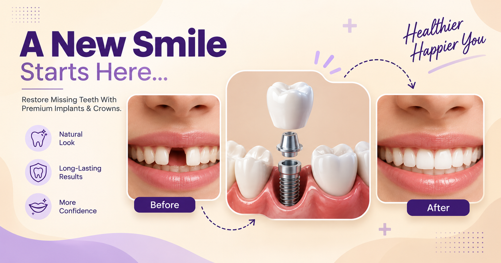 How to Choose the Best Clinic for a Dental Implant in Chandigarh