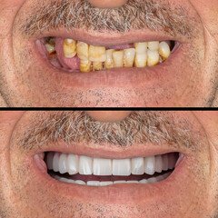 Smile Makeover