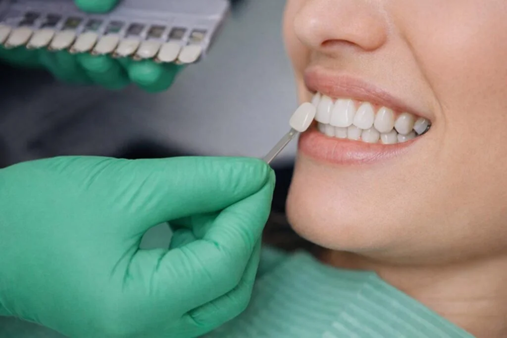 Dental Veneers in Mohali: A Personalized Approach to a Beautiful Smile