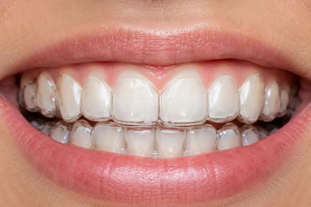 Invisalign vs Clear Aligners vs Braces: Which Teeth Straightening Option Is Right for You?