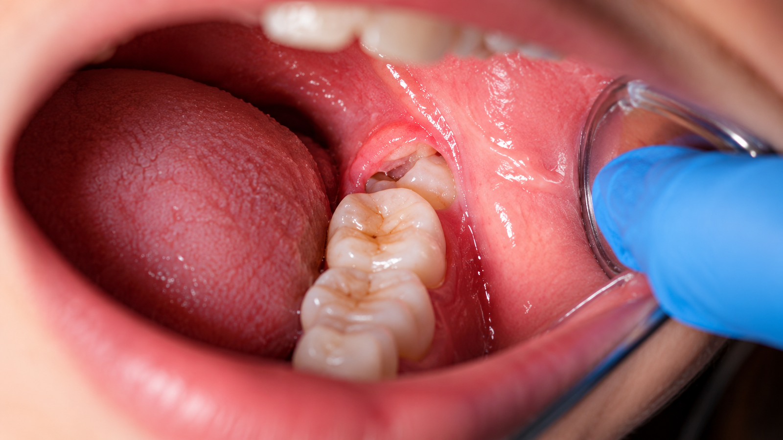 Wisdom Tooth Removal: Pain, Recovery Time & Aftercare Tips