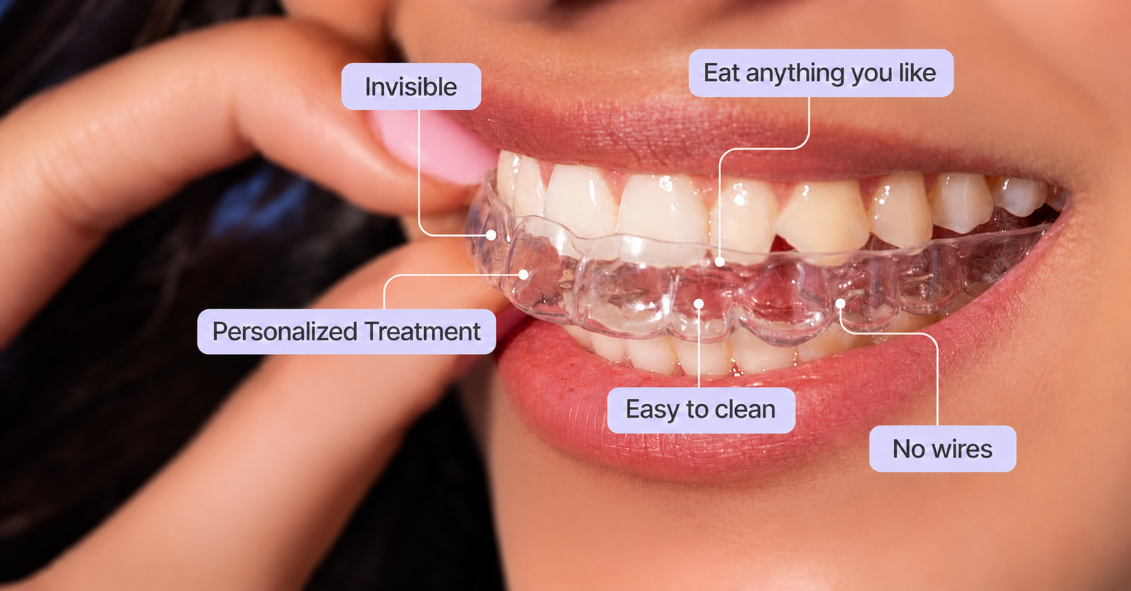 Invisalign Cost in Mohali: Price, Duration & Is It Worth It?