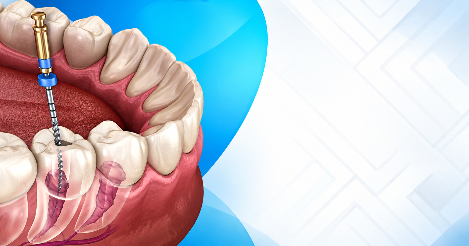 Root Canal Cost in Mohali: What You Should Expect to Pay