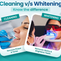 Teeth Cleaning vs Teeth Whitening: What Is the Difference and Which One Do You Need?