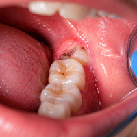 Wisdom Tooth Removal: Pain, Recovery Time & Aftercare Tips
