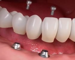 invisalign aligners