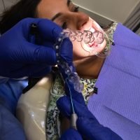 invisalign aligners