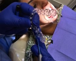 invisalign aligners