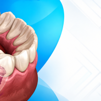 Root Canal Cost in Mohali: What You Should Expect to Pay