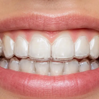 Invisalign vs Clear Aligners vs Braces: Which Teeth Straightening Option Is Right for You?